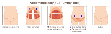 Seattle Tummy Tuck  Abdominoplasty - Anderson Sobel Cosmetic Surgery