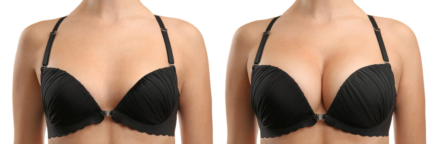 Tips for Bra Shopping After Breast Augmentation – TLKM Plastic Surgery